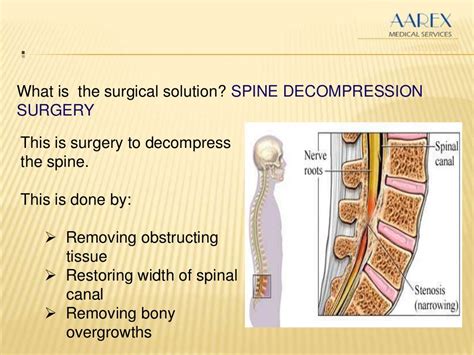 Spine Decompression Operation: Relieving Pressure, Restoring Mobility Safely