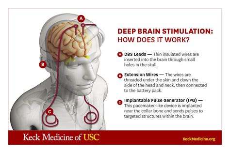 deep brain stimulation and depression