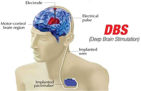 deep brain stimulation negative effects