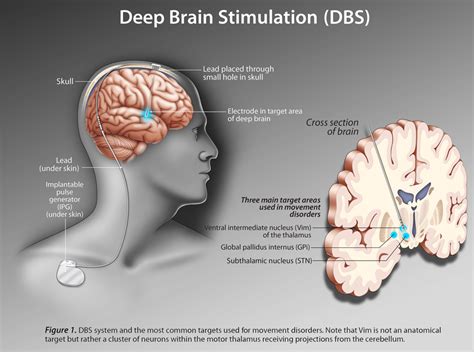 deep brain stimulation parkinson s target