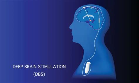 deep brain stimulation reviews