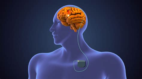 Unlocking Hope: How a Deep Brain Stimulator Can Transform Lives with Movement Disorders