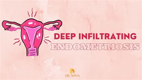 deep infiltrating endometriosis nhs