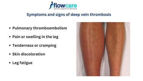 Understanding Deep Vein Thrombosis: Risks, Symptoms, and Prevention