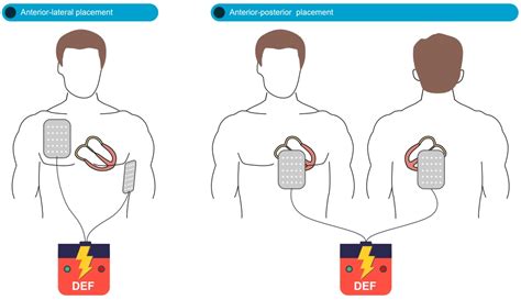 Defibrillation Pads Meaning