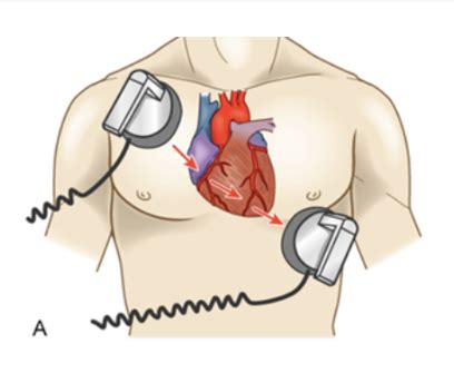Defibrillation Quizlet