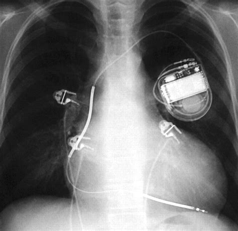 Defibrillator And Ct Scan