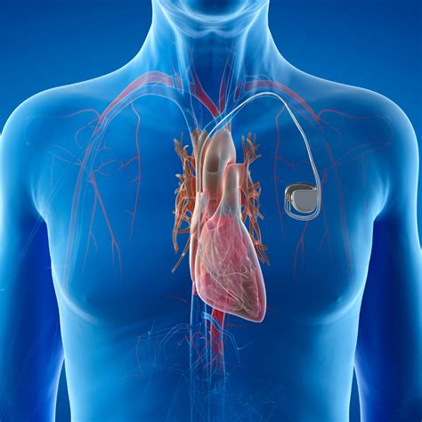 Defibrillator And Pacemaker Device