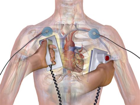 Defibrillator Cardioversion