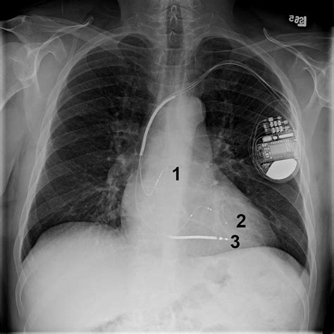 Defibrillator Cxr