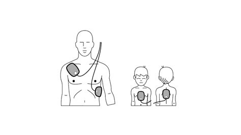 Defibrillator Elektroden Position