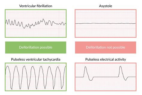 Defibrillator Heart Rhythms