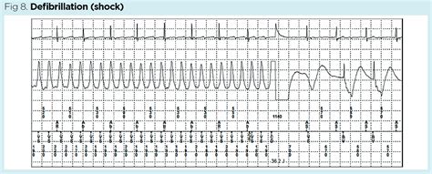 Defibrillator Shock Amount
