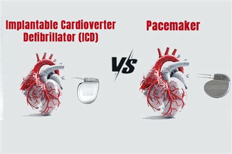 Defibrillator Vs Pacemaker Implant