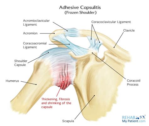 Define Adhesive Capsulitis