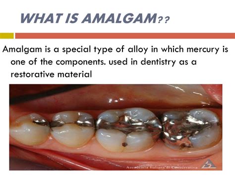 Define Amalgam With Example