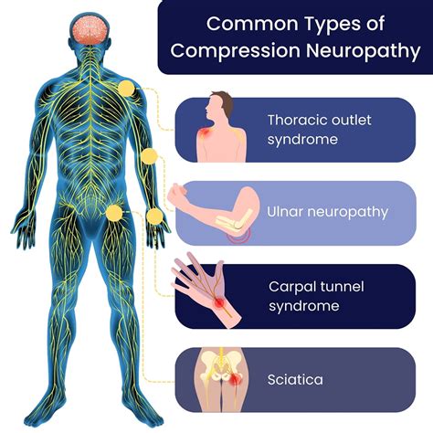 Define Compression Neuropathy