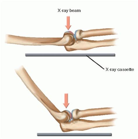 Define Dart Thrower's Elbow