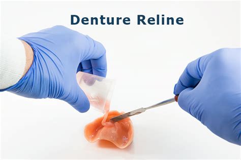 Define Dental Reline