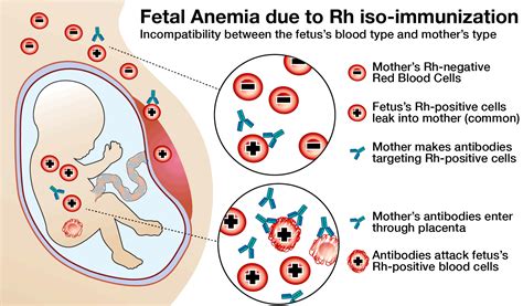 Define Fetal Anemia