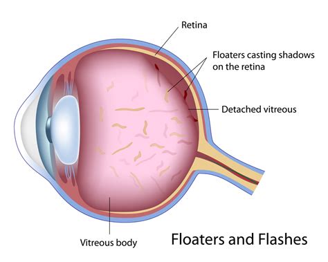 define posterior vitreous detachment