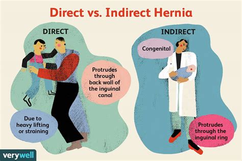 definition of direct and indirect hernia