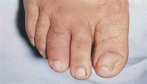 Definition Sausage Toe