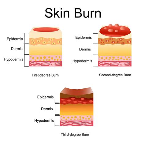 Understanding Degrees of Sunburn: Risks and Prevention Strategies