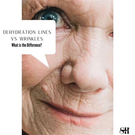 dehydration lines vs wrinkles