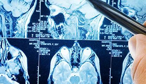 Dementia Brain Mri Images , MRI Scans Stock Image M140/0433 Science