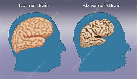 Dementia Brain Vs Normal Scientists Discover And Fix Risk Factor Of