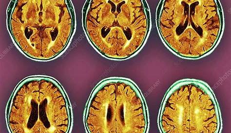 Dementia Patient Dementia Brain Scans , MRI Stock Image M140/0433 Science
