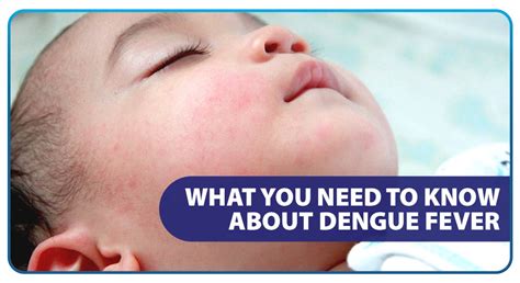 dengue fever symptoms in babies