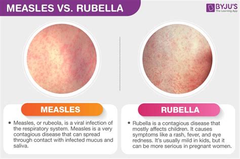 dengue rash vs measles rash
