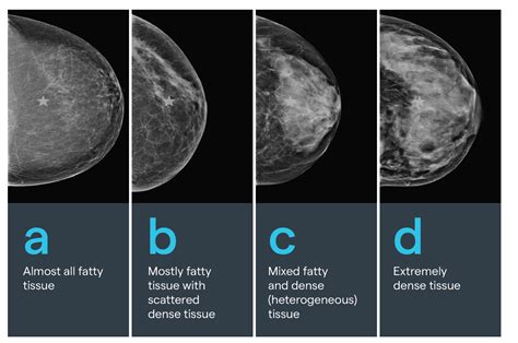 Understanding Dense Breast Tissue Mammogram: What You Need to Know About Accurate Breast Cancer Detection