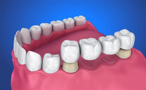 What are dental bridges? Willows Dentistry