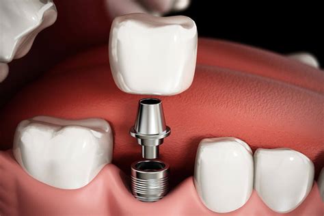 Loose Dental Implant Southside Dental Implants, Brisbane