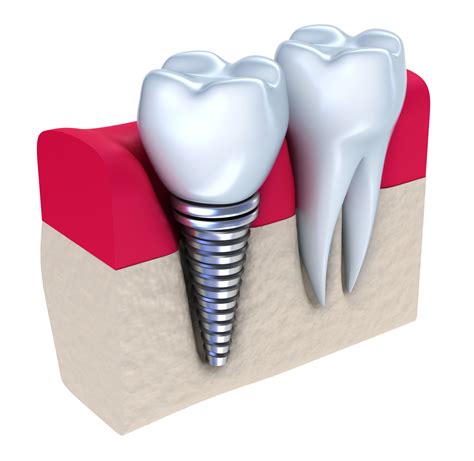 Dentures Dentist Dental Implants Port St. Lucie, Florida Affordable