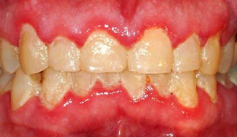 Dental Plaque Induced Gingival Disease s