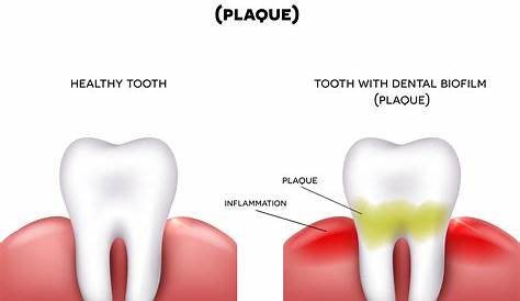 Dental Plaque Symptoms All About BuildUp Burwood Care