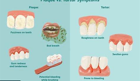 Plaque vs. Tartar What’s The Difference? Family