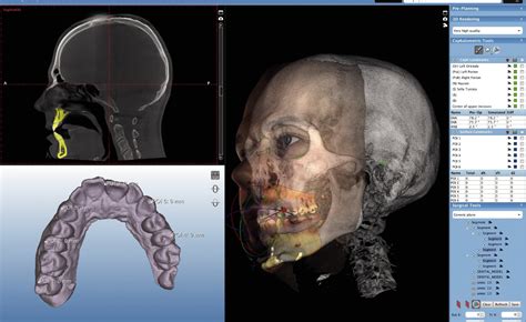 dental 3d scan cpt code