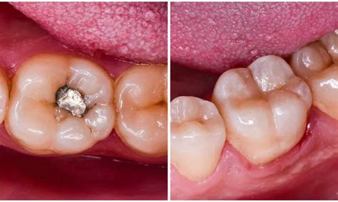 Dental Amalgam Debate