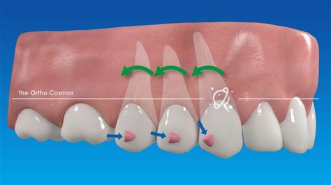 Dental Attachments
