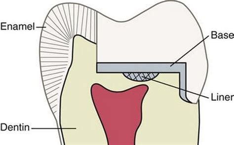 Dental Base Vs Liner
