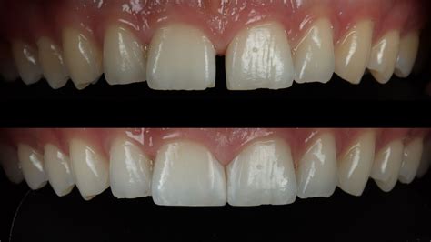 Dental Bonding Close Gap
