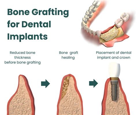 Dental Bone Graft Paste