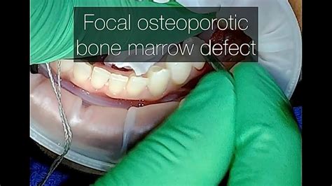 Dental Bone Marrow
