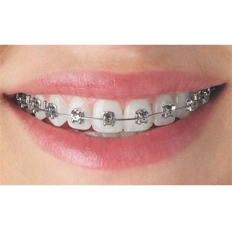 Dental Braces Ligating