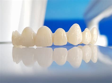 dental bridge cost in dubai